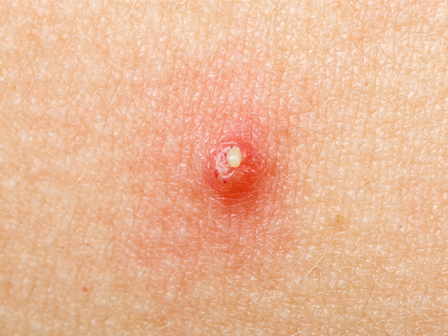 Antibiyotik İçermeyen Akne Tedavisi için Mikroiğneli Yama