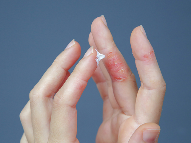 Atopik Dermatit: Yeni Tedavi Seçeneği Olarak Virüsler Keşfedildi