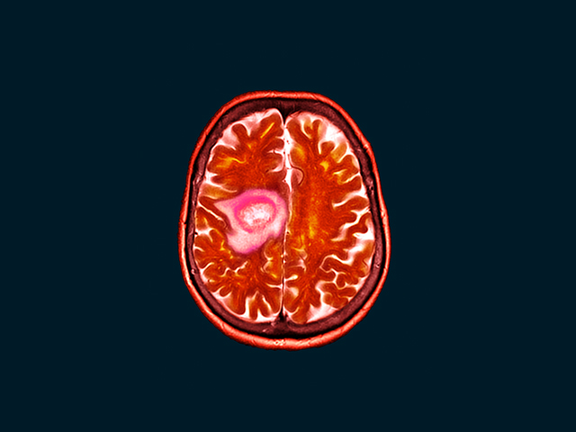 Salınımlı Manyetik Alan Glioblastoma Tümörünü Küçültüyor