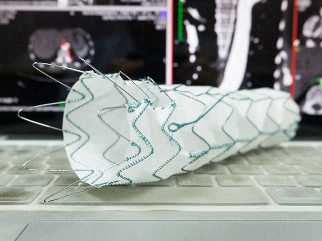 Lokalize İlaç Dağıtımı için Kirigami Stent