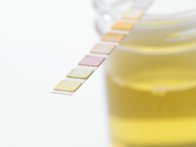 İdrardan Beyin Tümörlerini Saptayan Nanotel Test