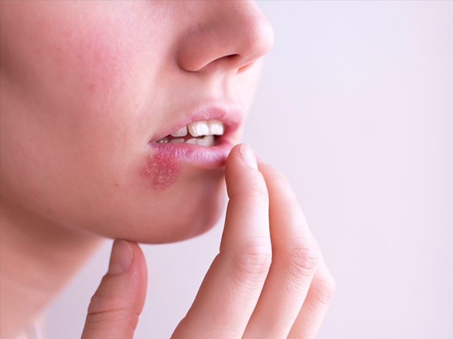Herpes Virüsünden Sonra Çift Kat Demans Riski