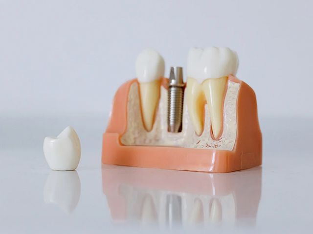 Ekoloji-Dostu Titanyum Dental İmplantlar