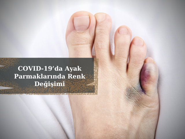 COVID-19’da Ayak Parmaklarında Renk Değişimi Şikâyetlerinde Artış Oldu