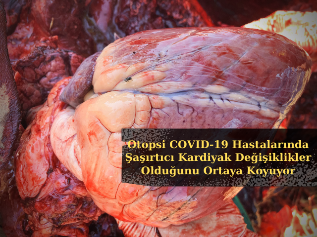 Otopsi COVID-19 Hastalarında Şaşırtıcı Kardiyak Değişiklikler Olduğunu Ortaya Koyuyor